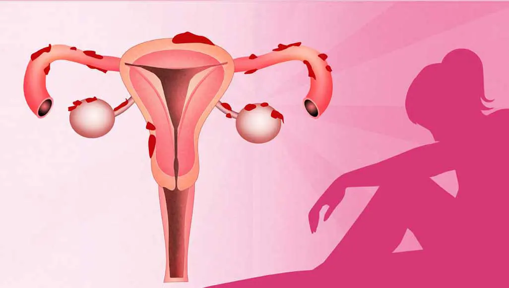 Tratamiento efectivo para la endometriosis